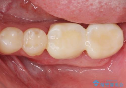 APF(歯肉弁根尖側移動術)の治療後