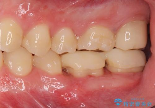 APF(歯肉弁根尖側移動術)の症例 治療後
