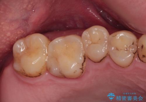 部分矯正で咬み合わせを改善　奥歯のインプラント治療の治療前
