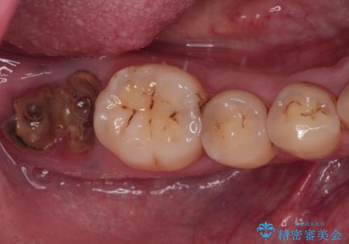部分矯正で咬み合わせを改善　奥歯のインプラント治療の症例 治療前