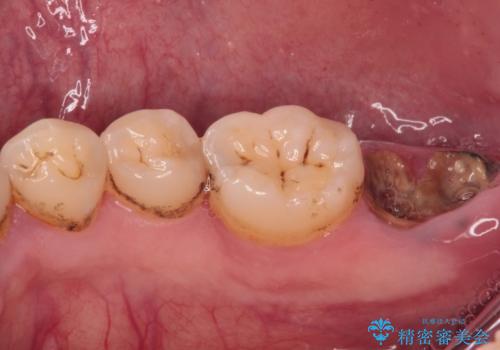 部分矯正で咬み合わせを改善 奥歯のインプラント治療の治療前