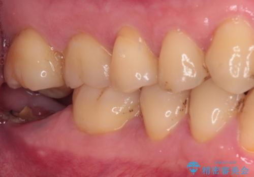 部分矯正で咬み合わせを改善 奥歯のインプラント治療の治療前