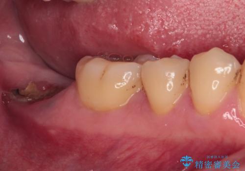 部分矯正で咬み合わせを改善 奥歯のインプラント治療の治療前