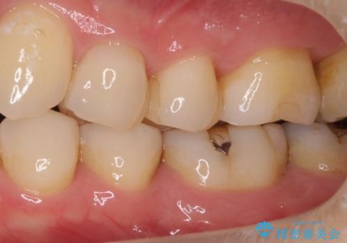 銀歯の横が虫歯、自費治療でやり直してセラミックにの治療前