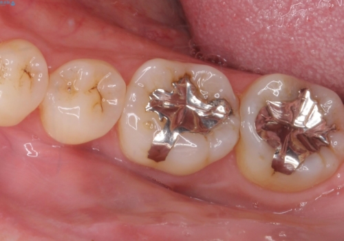 銀歯の横が虫歯、自費治療でやり直してセラミックに