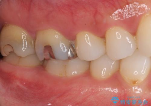 歯周外科処置を併用した奥歯のむし歯治療の治療前