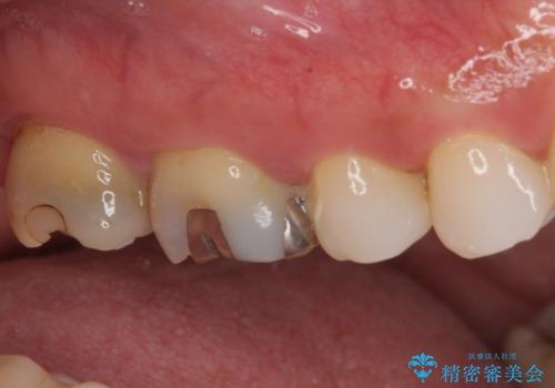 歯周外科処置を併用した奥歯のむし歯治療の治療前