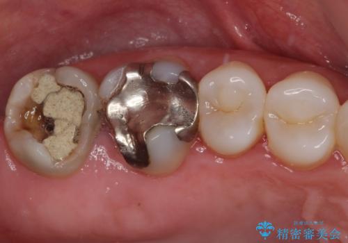 歯周外科処置を併用した奥歯のむし歯治療の症例 治療前