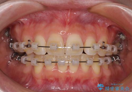 矯正の後戻りと奥歯の欠損 ワイヤー矯正とインプラント治療の治療中