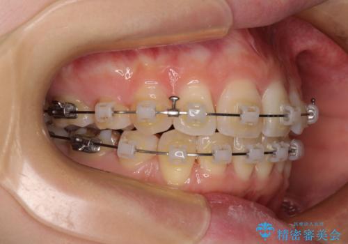 矯正の後戻りと奥歯の欠損 ワイヤー矯正とインプラント治療の治療中