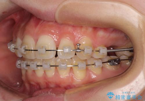 矯正の後戻りと奥歯の欠損 ワイヤー矯正とインプラント治療の治療中