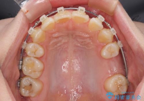 矯正の後戻りと奥歯の欠損 ワイヤー矯正とインプラント治療の治療中