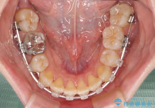 矯正の後戻りと奥歯の欠損 ワイヤー矯正とインプラント治療の治療中