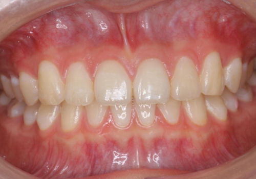 前歯のすき間が気になる　部分矯正での症例 治療後