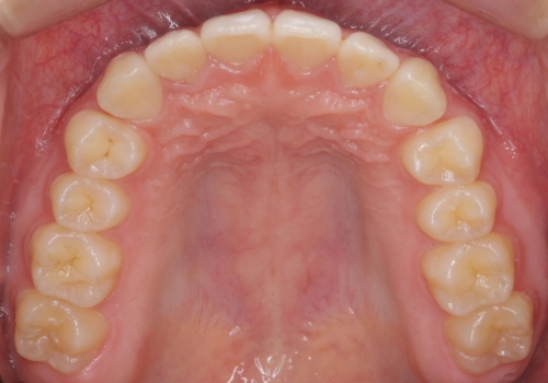 前歯のすき間が気になる 部分矯正での治療後