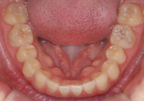 前歯のすき間が気になる 部分矯正での治療後