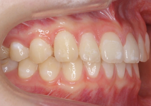 前歯のすき間が気になる　部分矯正での治療後