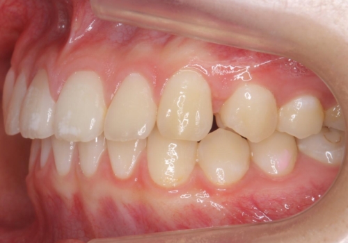 前歯のすき間が気になる　部分矯正での治療後