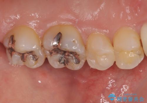 歯に穴があいてフロスが引っかかる　セラミックインレー修復の治療後