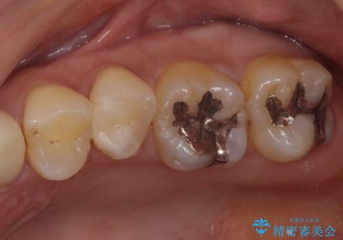 歯に穴があいてフロスが引っかかる セラミックインレー修復の治療後