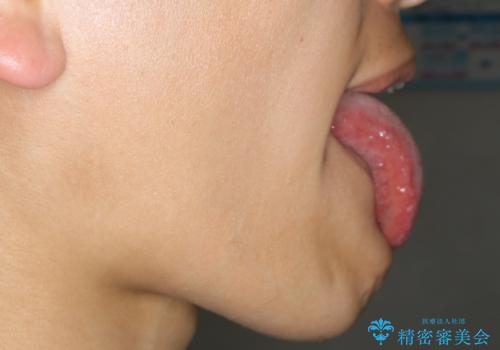 舌小帯切除　レーザー機器で縫合レスの治療後