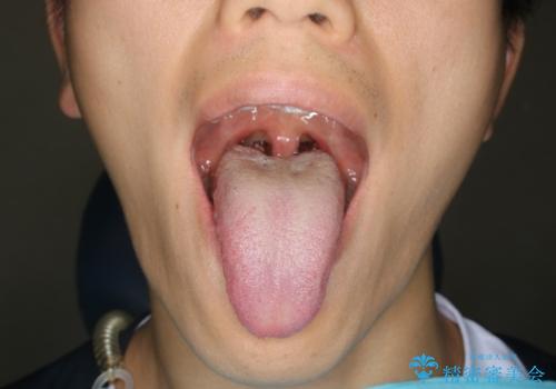 舌小帯切除　レーザー機器で縫合レスの治療後