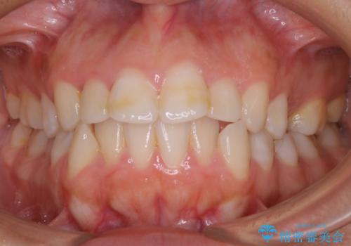 【抜歯】口元を引っ込めたい ワイヤー矯正の治療前