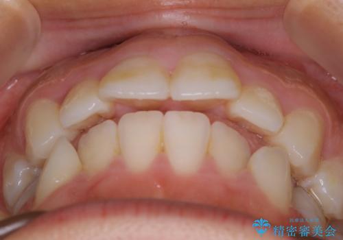 【抜歯】口元を引っ込めたい ワイヤー矯正の治療前