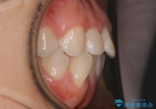 【抜歯】口元を引っ込めたい ワイヤー矯正の治療前