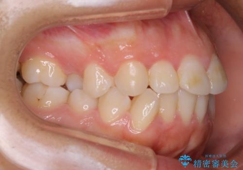 【抜歯】口元を引っ込めたい ワイヤー矯正の治療前