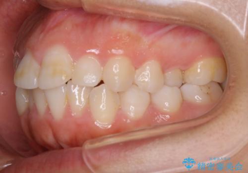 【抜歯】口元を引っ込めたい ワイヤー矯正の治療前