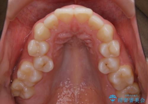 【抜歯】口元を引っ込めたい ワイヤー矯正の治療前