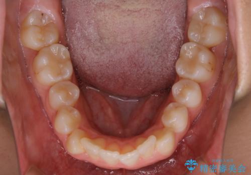 【抜歯】口元を引っ込めたい ワイヤー矯正の治療前