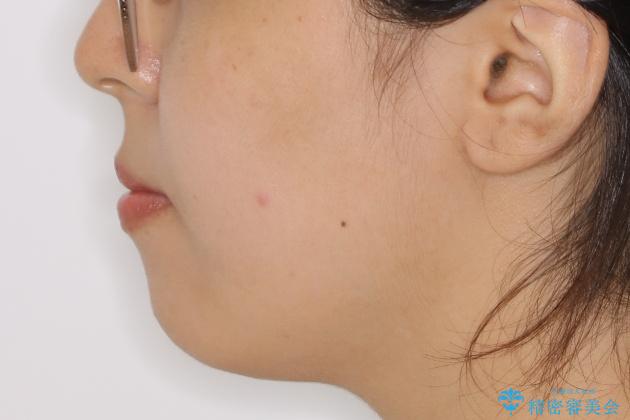 【抜歯】口元を引っ込めたい ワイヤー矯正の治療前(顔貌)