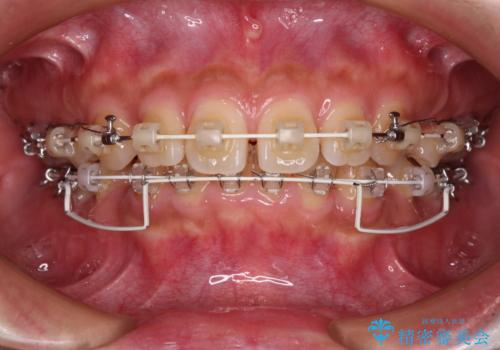 くちばしのような前歯 抜歯矯正で口を閉じやすくの治療中