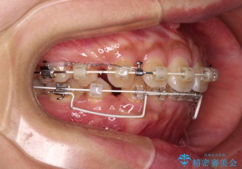 くちばしのような前歯 抜歯矯正で口を閉じやすくの治療中