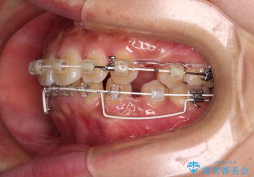 くちばしのような前歯 抜歯矯正で口を閉じやすくの治療中