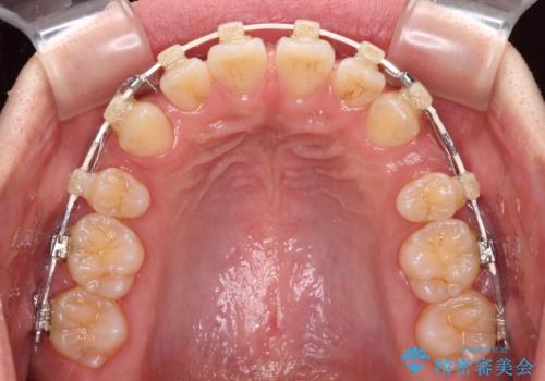 くちばしのような前歯 抜歯矯正で口を閉じやすくの治療中