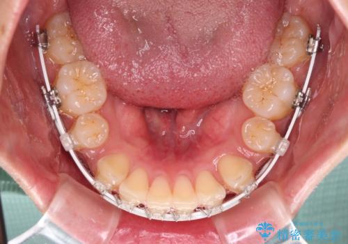 くちばしのような前歯　抜歯矯正で口を閉じやすくの治療中