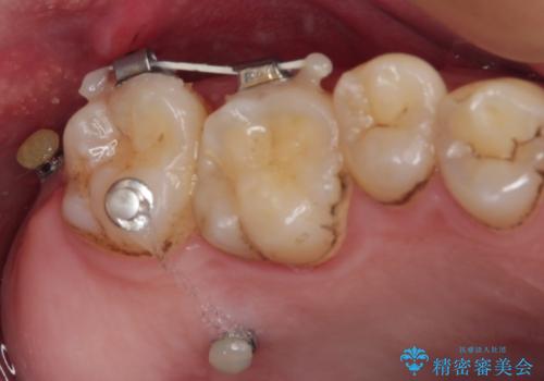 部分矯正で咬み合わせを改善 奥歯のインプラント治療の治療中