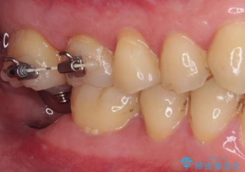 部分矯正で咬み合わせを改善 奥歯のインプラント治療の治療中