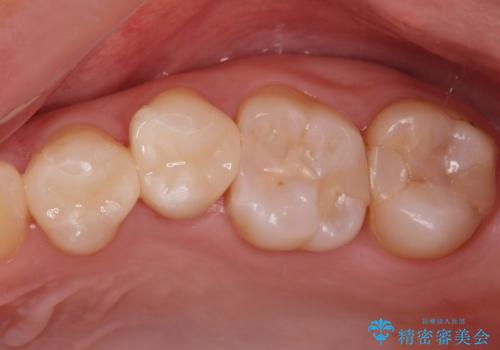 e-maxインレー治療の治療後