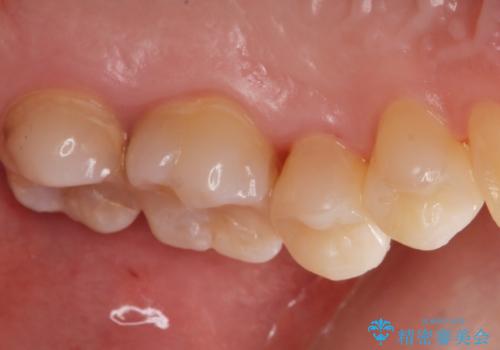 e-maxインレー治療の治療後