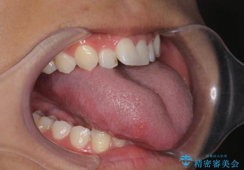 舌が動かしにくい。の治療後