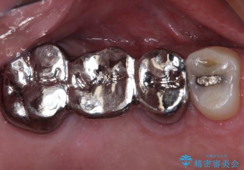奥歯のブリッジが痛い　オールセラミックブリッジでのむし歯治療の症例 治療前