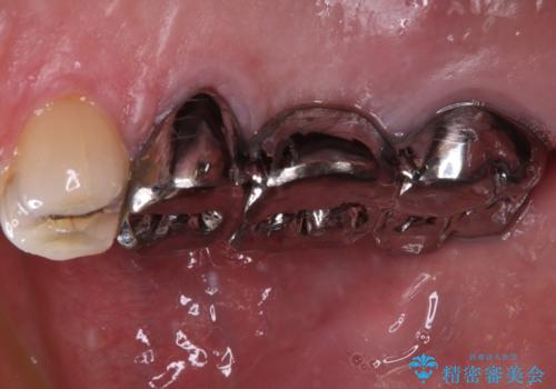 奥歯のブリッジが痛い オールセラミックブリッジでのむし歯治療の治療前