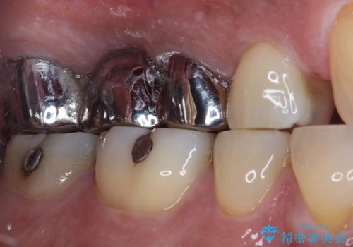 奥歯のブリッジが痛い オールセラミックブリッジでのむし歯治療の治療前
