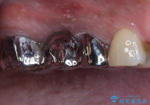 奥歯のブリッジが痛い オールセラミックブリッジでのむし歯治療の治療前