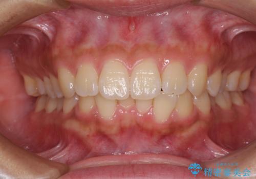 くちばしのような前歯　抜歯矯正で口を閉じやすくの症例 治療前
