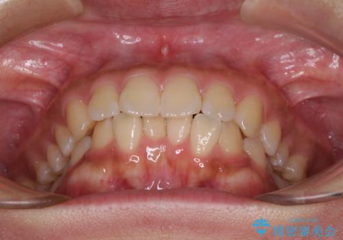 くちばしのような前歯 抜歯矯正で口を閉じやすくの治療前